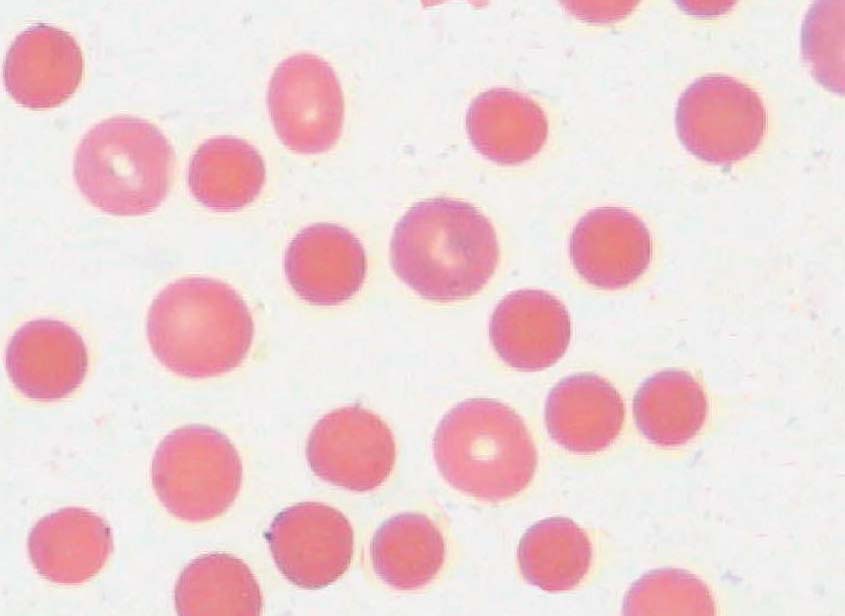 球形红细胞